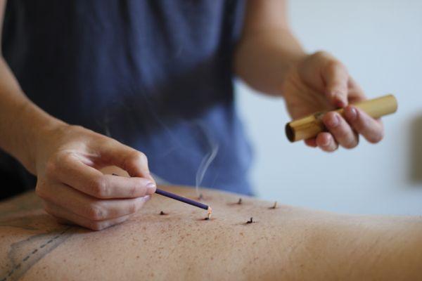 Moxibustion