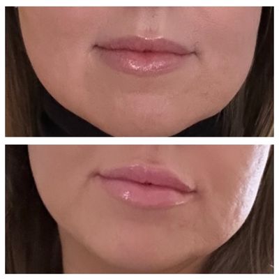 Before above, below is after. My lips came out perfect!