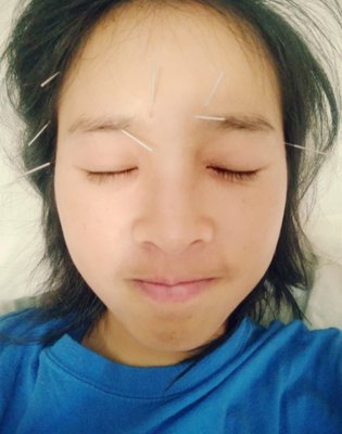 I had a headache for 3 days. Dr. Tsao helped to reduce the pain a whole lot and I was fine by the time I left the clinic.