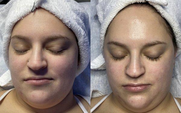 Myranda Beauty Facial with a dermaplane