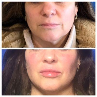 Before and After facial Sculpting with Filler Injections