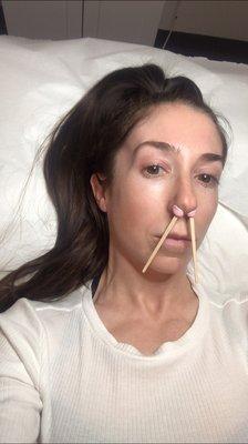 Nose Hair Removal