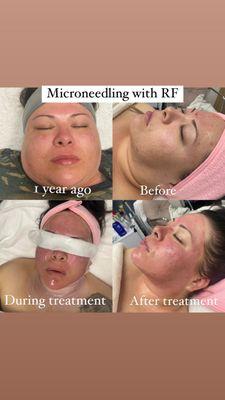 Microneedling treatment with RF
Helps with acne scars, wrinkles, and much more.