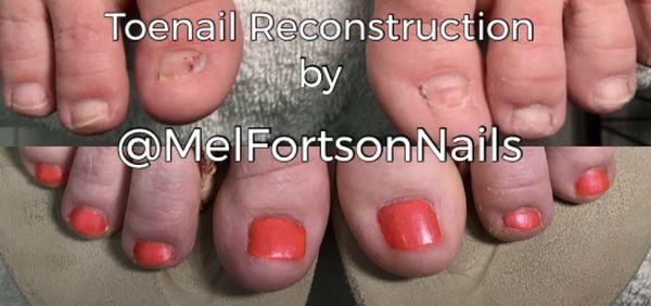 I'm proud to offer toenail reconstruction using LCN Barefoot System- unlike acrylic, it's flexible, non-porous & safe to use on bare skin!