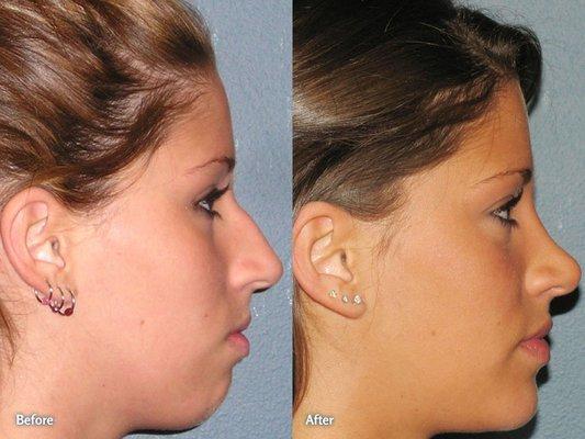 Rhinoplasty & Genioplasty (Chin Implant)