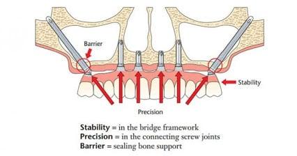 Zygoma implant's