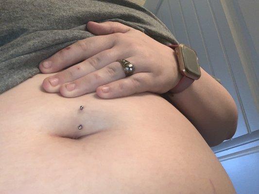 my belly ring on the first day. you can see it's crooked and there was way too much skin pierced.