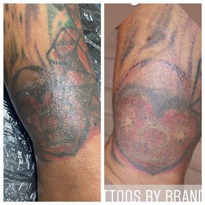 Laser tattoo removal after first treatment