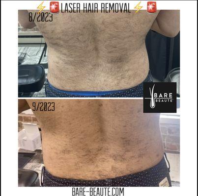 Laser hair removal treatment.  

Bare-Beaute.com
‍‍