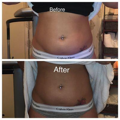 Before and after only one 45 minute Cavi-Lipo treatment!