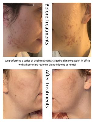 Before & after series of peel treatments