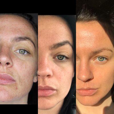 Series Of Resurfacing Treatments