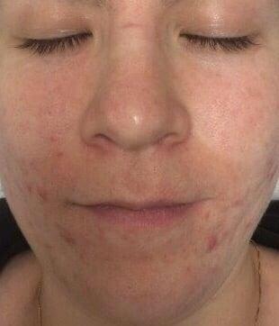 Before High Frequency and a Series of Microdermabrasion