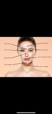 Where Botox can make a difference on your face.