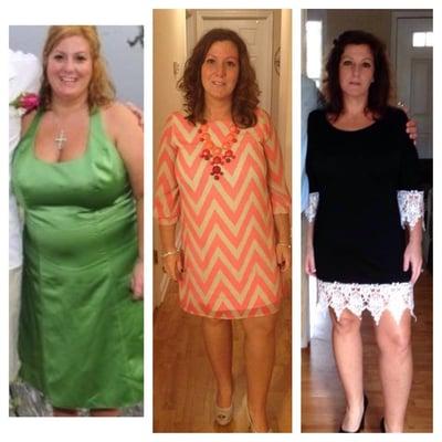 Before and after pics of patient at Bariatric Specialists of NC.