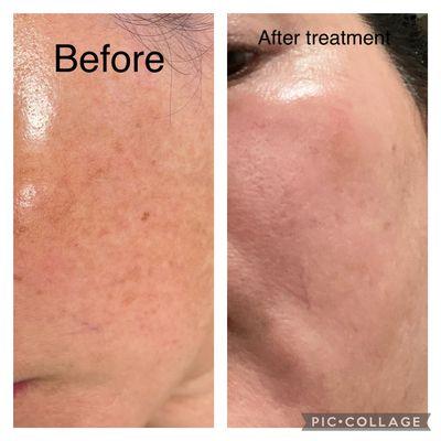 Melasma treatment