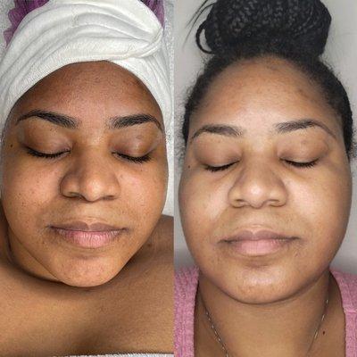 The Herbal Green Peel Fresh Up 1 Treatment