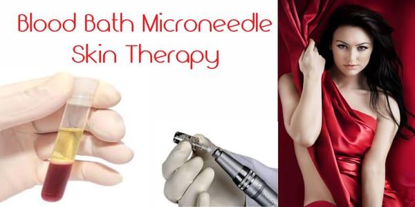 Blood Bath Microneedle Skin Therapy PRP