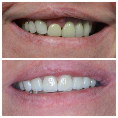 Anterior cosmetic makeover @wparkdental