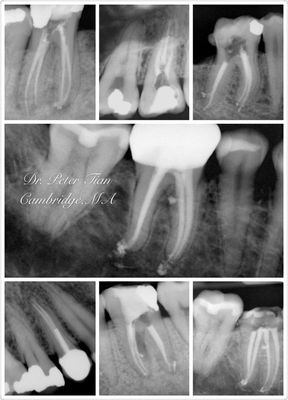 Some challenged Root Canal Treatment cases - RCT