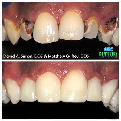 Don't let your smile hold you back!  We were able to achieve this transformation in just one visit with cosmetic composite bonding.