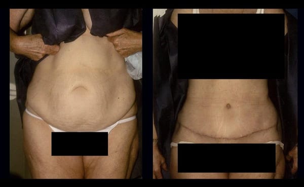 Abdominoplasty