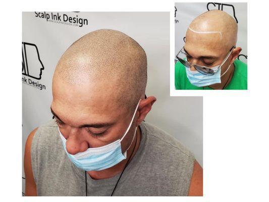 Scalp Micropigmentation Before and After - Shaved Look