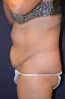 #5850 ABDOMINOPLASTY - 58 YEAR OLD, PRE-OP