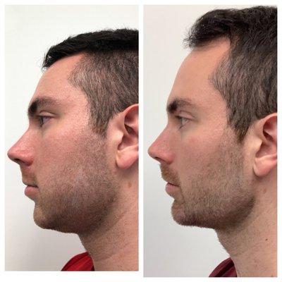 Kybella & Jawline Filler