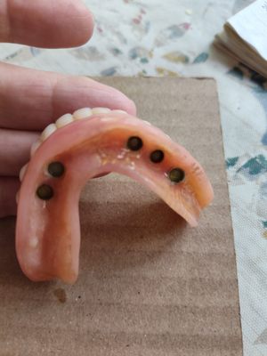 This is the horrible over denture the was so nasty.