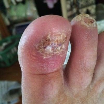 This photo was taken two days ago as you can see my toe is in very bad shape in the possibility of losing it also my second toe.