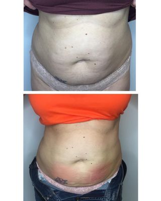 Top picture is before 1st cryoslimming treatment bottom is after 2nd cryoslimming treatment (client saw a 2 inch reduction!)