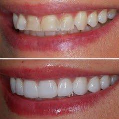 Before and After at NÜVA Smile | Clifton, NJ