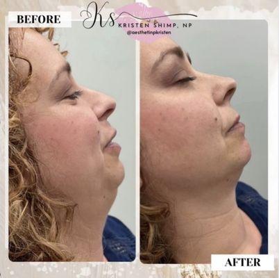 Chin and Jaw filler