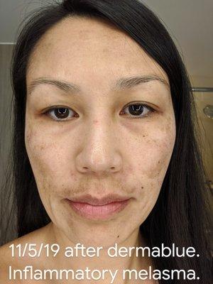 The treatment prescribed inflamed my skin and caused more melasma instead of fading it