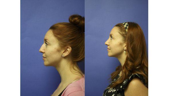 Rhinoplasty Before and After