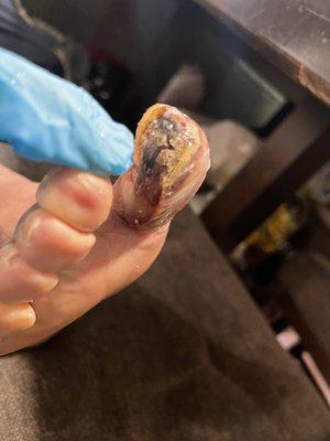 Infected toe nail  Infection en e dedo