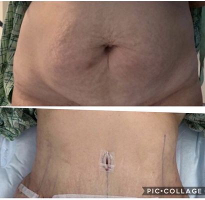 Tummy tuck!