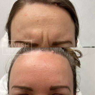 Botox for frown line before & after