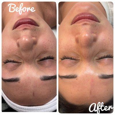 Brightening Facial