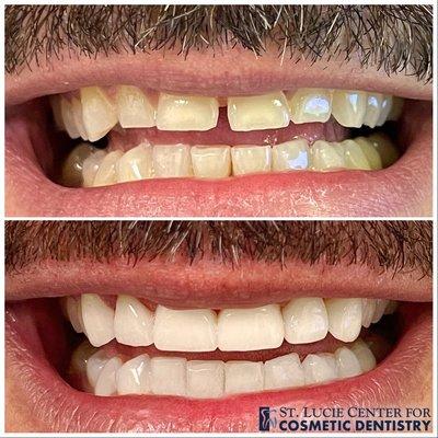 Cosmetic Crowns on Upper only with zoom whitening