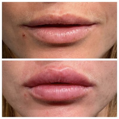 Lip Filler