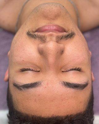 Hydrofacial Before