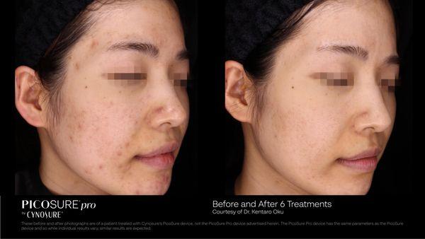 Before and after treatment for acne scar and skin resurfacing