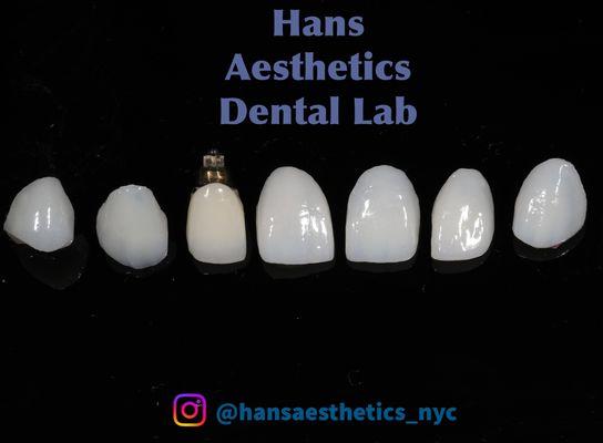 Hans Aesthetics Dental lab Aesthetics Porcelain veneers, cosmetic dentistry Aesthetic dental lab nyc dental lab feldspathic veneers