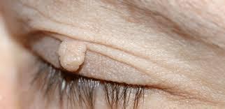 Skin Tag on eyes? We can treat those Too!