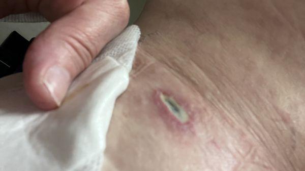 Liposuction site. 10 days later. After the full course of antibiotics and antibiotic ointment.