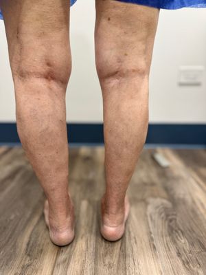 Varicose veins are especially prominent at the back of the legs were most of us cannot even examine properly