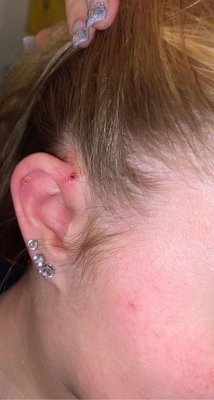 Immediately after piercing removal (1)