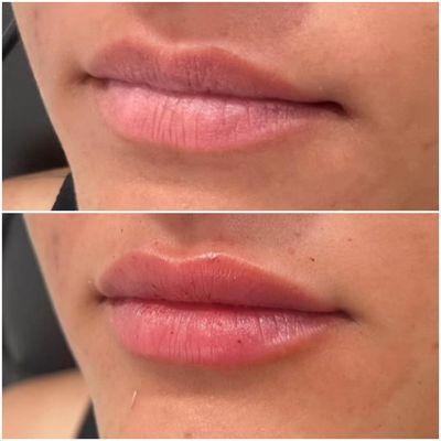 Lip augmentation can change the shape of the lips, create smooth lips, add volume and create a natural appearance.